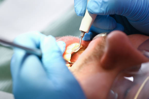 Best Emergency Dental Care for Broken or Chipped Teeth in Lexington, MN